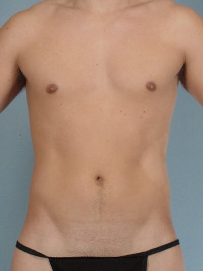 Abdominal Etching Before & After Gallery - Patient 223853 - Image 1