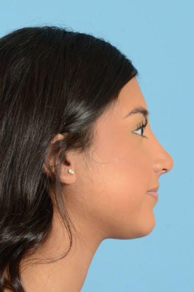 Rhinoplasty Before & After Gallery - Patient 220202 - Image 8