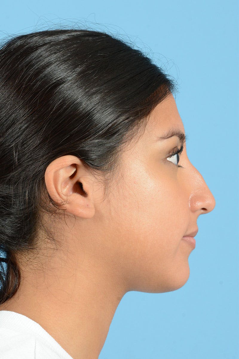 Rhinoplasty Before & After Gallery - Patient 220202 - Image 7