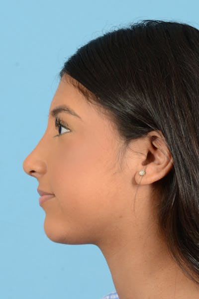 Rhinoplasty Before & After Gallery - Patient 220202 - Image 6