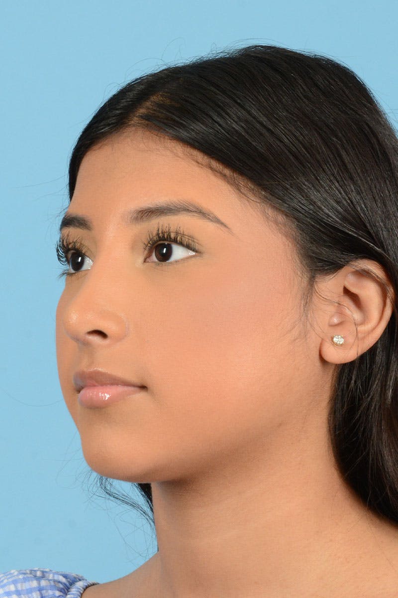 Rhinoplasty Before & After Gallery - Patient 220202 - Image 4