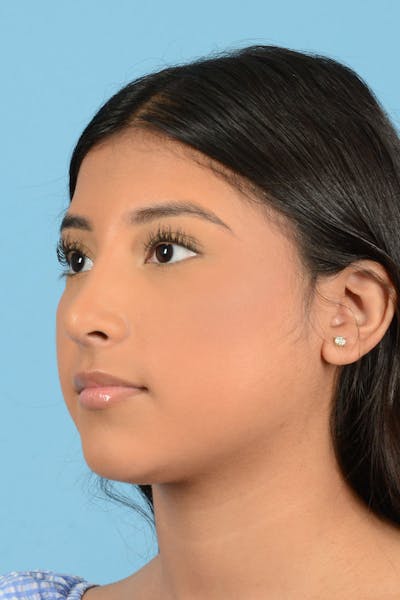 Rhinoplasty Before & After Gallery - Patient 220202 - Image 4