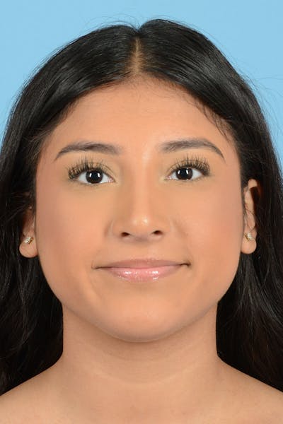 Rhinoplasty Before & After Gallery - Patient 220202 - Image 2