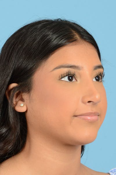 Rhinoplasty Before & After Gallery - Patient 220202 - Image 10