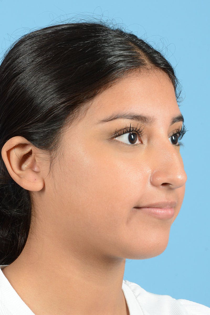 Rhinoplasty Before & After Gallery - Patient 220202 - Image 9