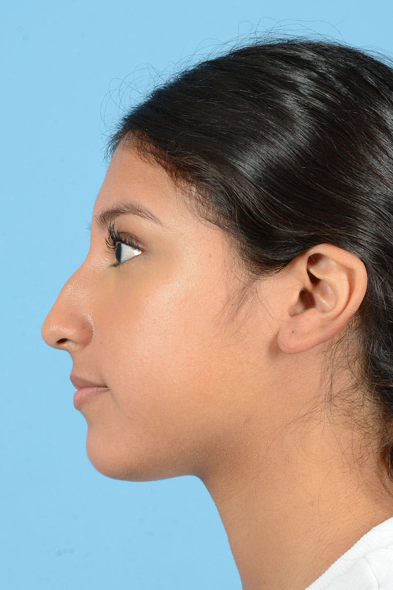 Rhinoplasty Before & After Gallery - Patient 220202 - Image 5