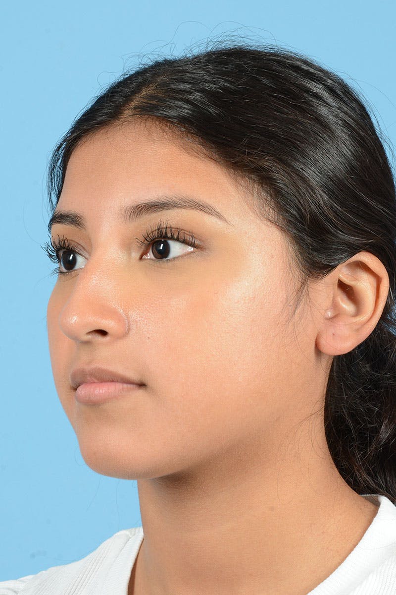 Rhinoplasty Before & After Gallery - Patient 220202 - Image 3