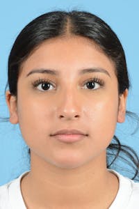 Rhinoplasty Before & After Gallery - Patient 220202 - Image 1