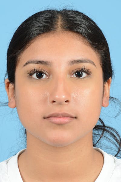 Rhinoplasty Before & After Gallery - Patient 220202 - Image 1