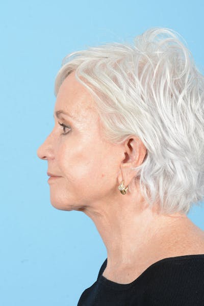 Facelift Before & After Gallery - Patient 301249 - Image 8