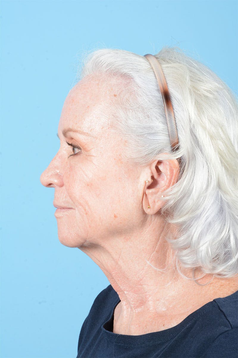 Facelift Before & After Gallery - Patient 301249 - Image 7