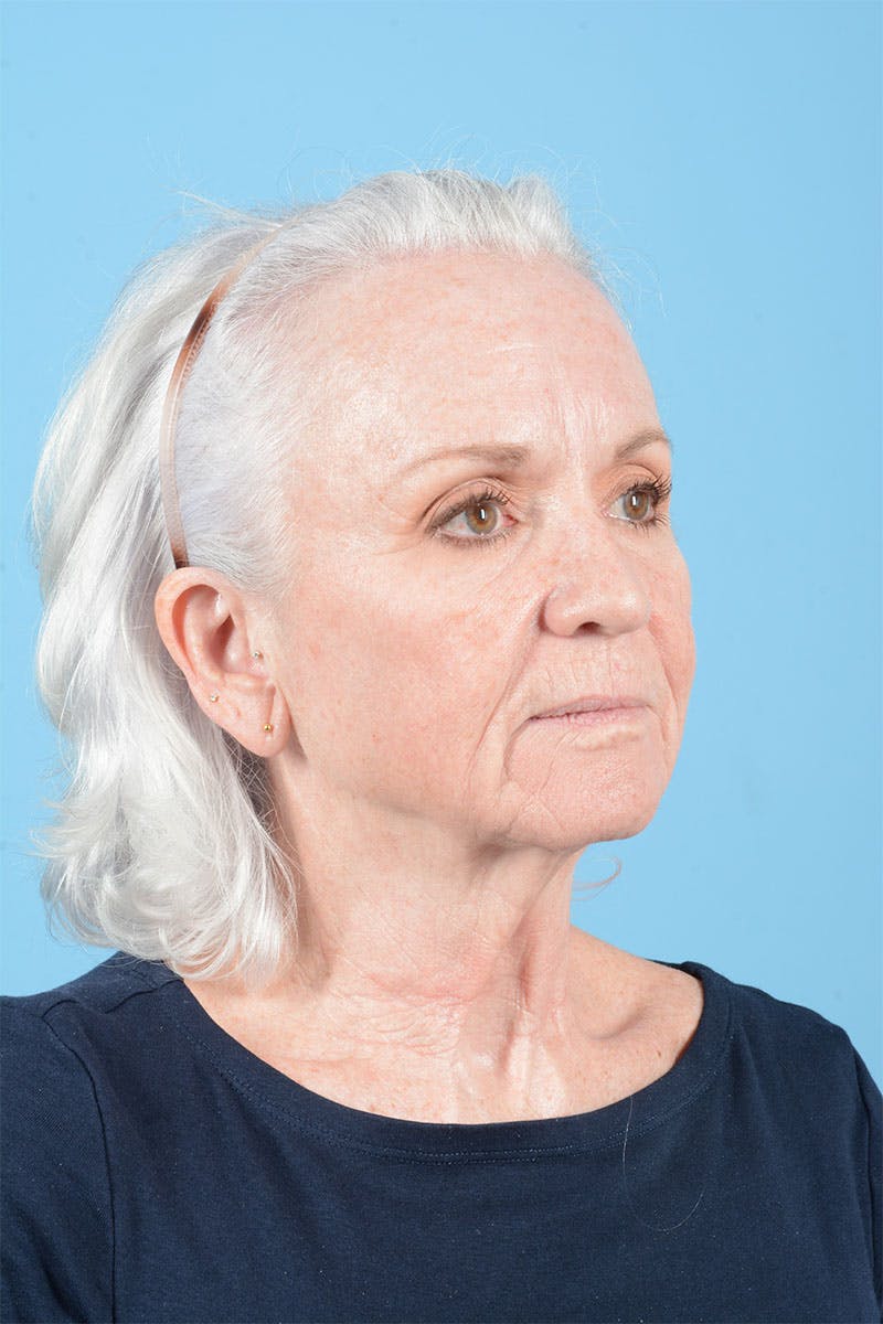Facelift Before & After Gallery - Patient 301249 - Image 11