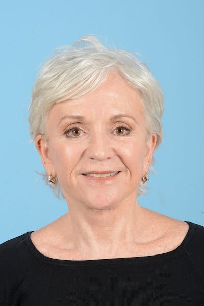 Facelift Before & After Gallery - Patient 301249 - Image 4