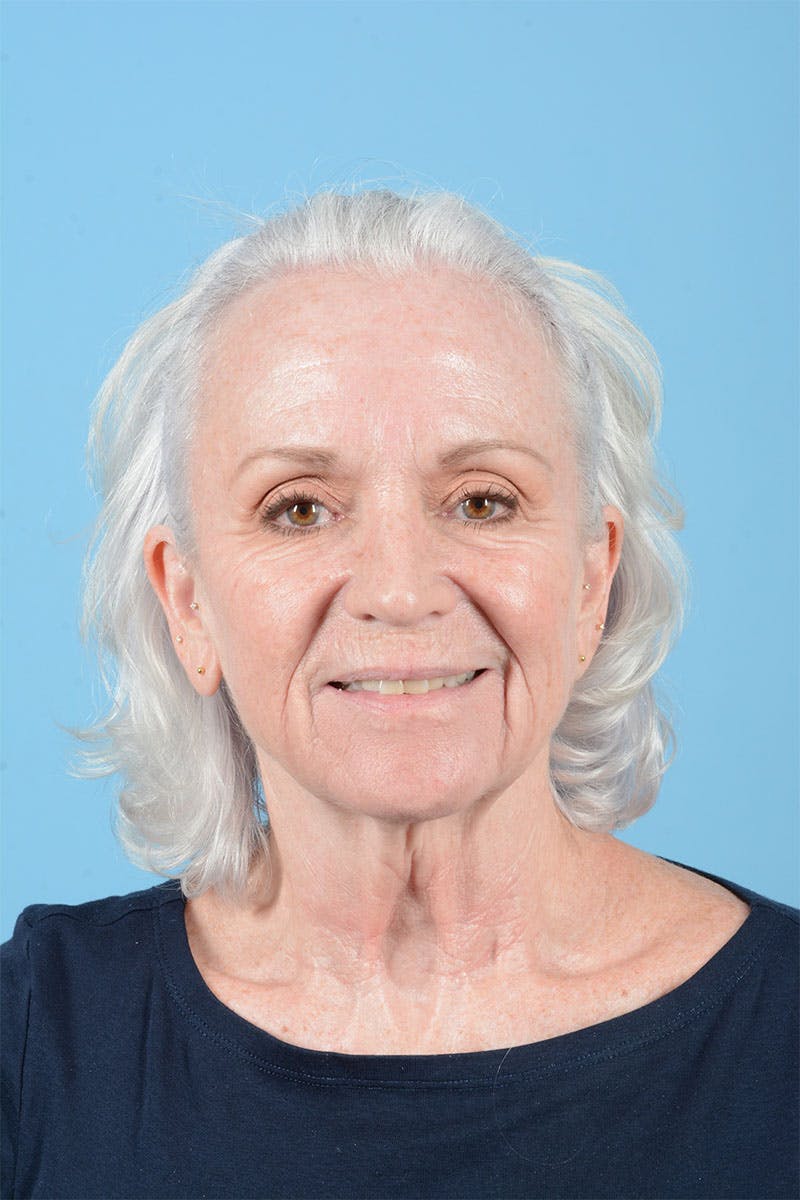 Facelift Before & After Gallery - Patient 301249 - Image 3