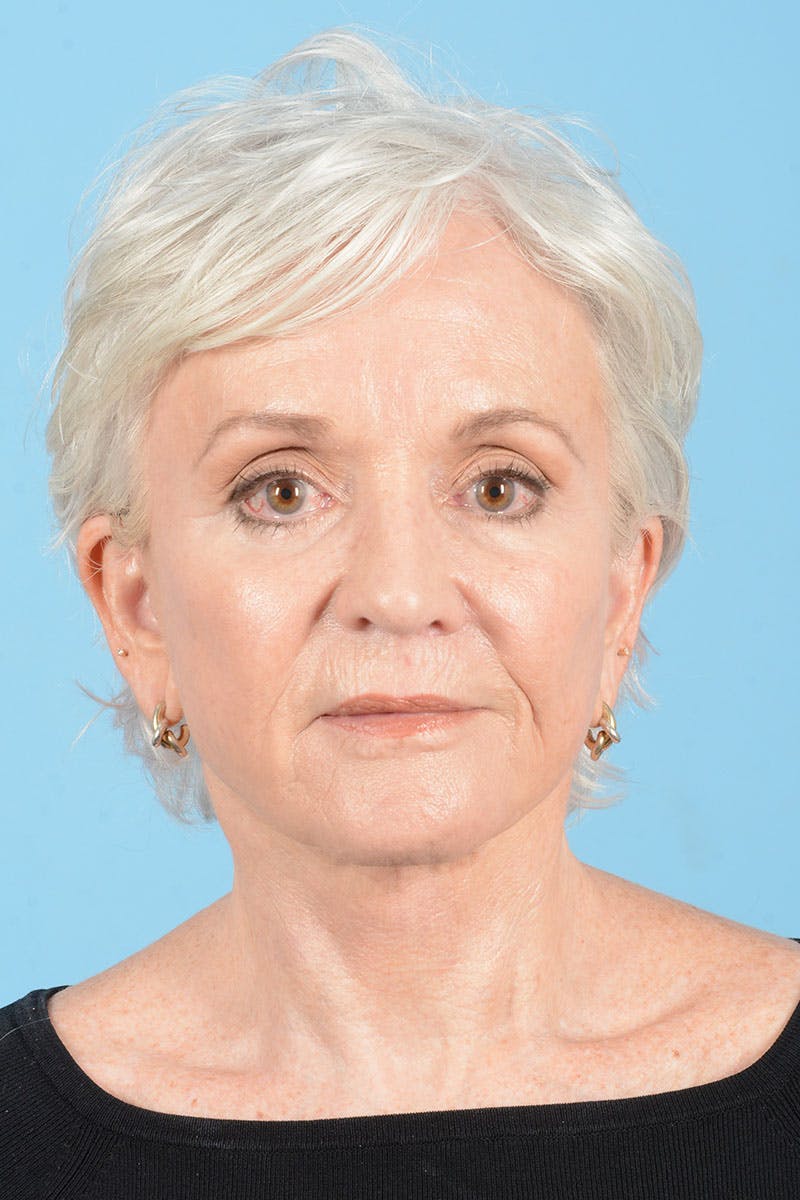 Facelift Before & After Gallery - Patient 301249 - Image 2