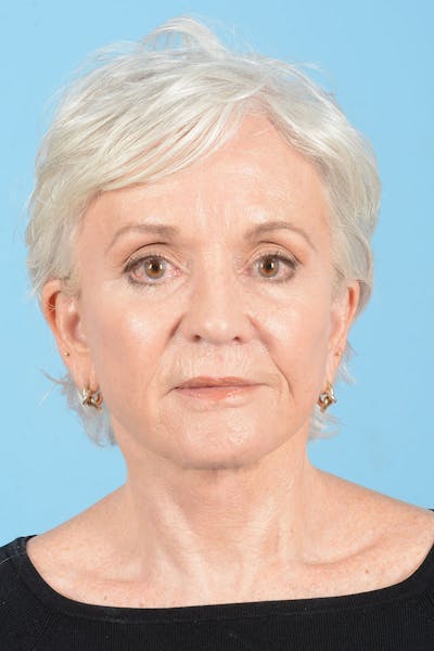 Facelift Before & After Gallery - Patient 301249 - Image 2