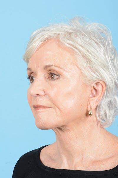 Facelift Before & After Gallery - Patient 301249 - Image 6