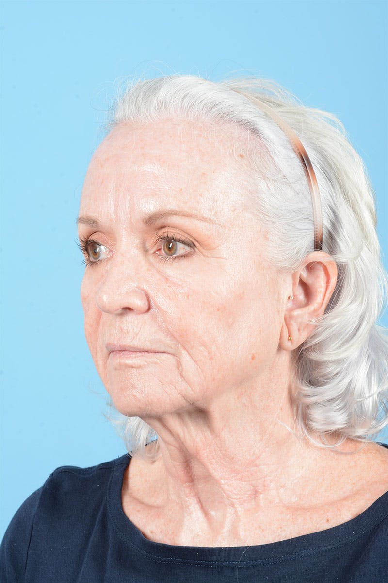 Facelift Before & After Gallery - Patient 301249 - Image 5