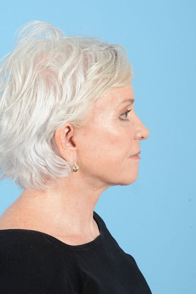 Facelift Before & After Gallery - Patient 301249 - Image 10