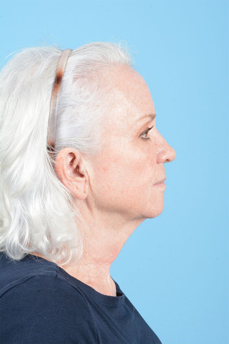 Facelift Before & After Gallery - Patient 301249 - Image 9