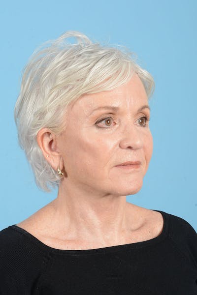 Facelift Before & After Gallery - Patient 301249 - Image 12