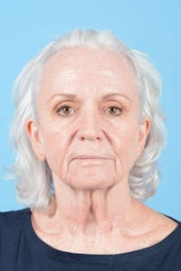 Facelift Before & After Gallery - Patient 301249 - Image 1