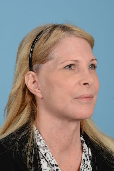 Facelift Before & After Gallery - Patient 188484 - Image 12
