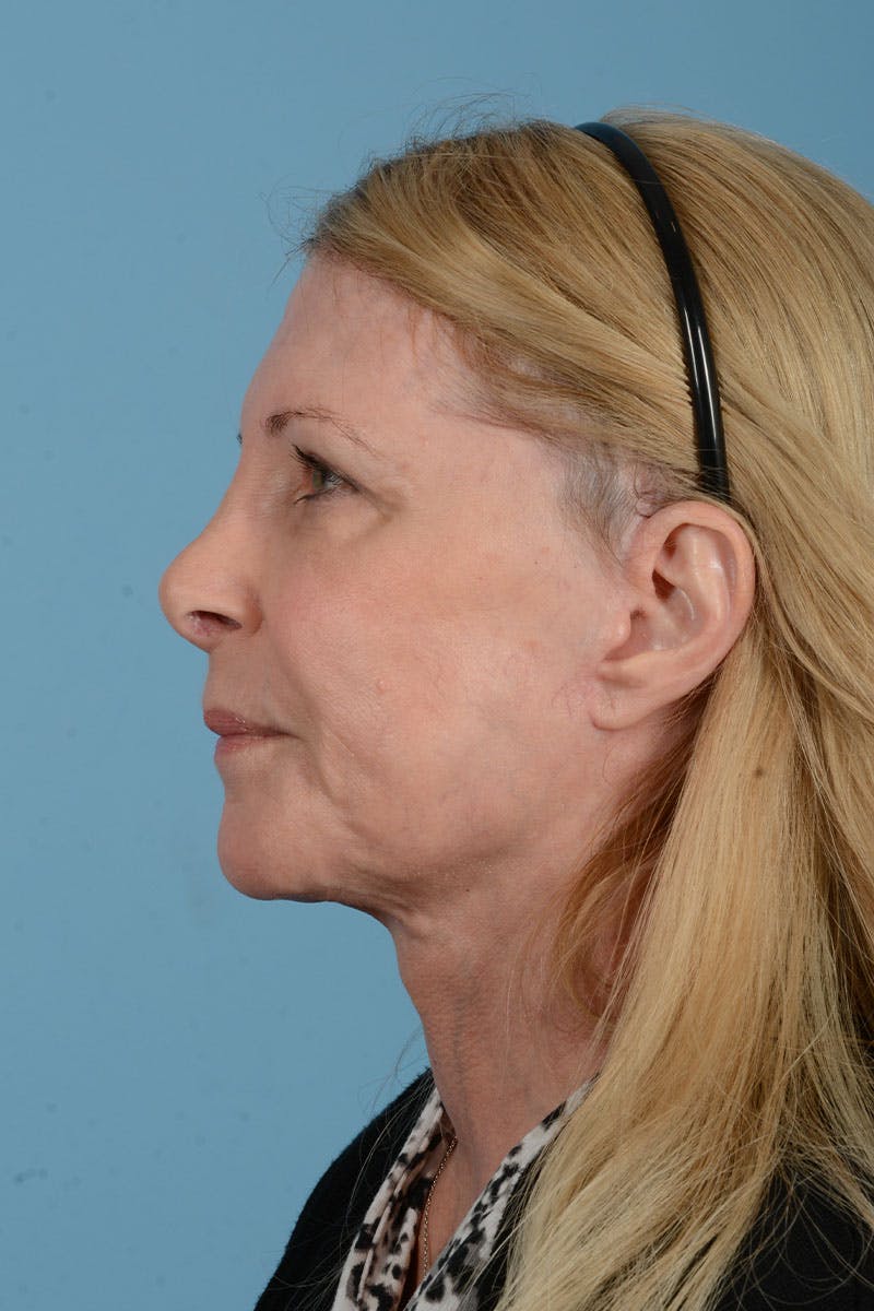 Facelift Before & After Gallery - Patient 188484 - Image 8