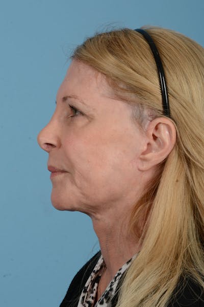Facelift Before & After Gallery - Patient 188484 - Image 8