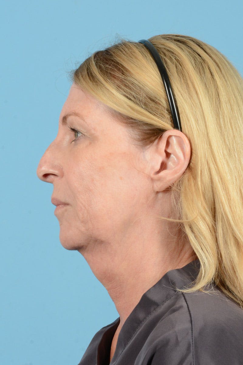 Facelift Before & After Gallery - Patient 188484 - Image 7