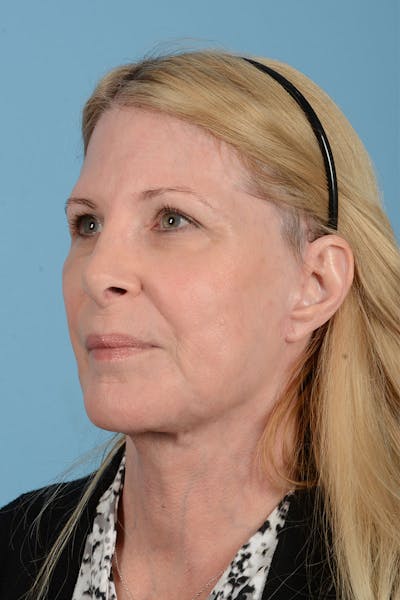 Facelift Before & After Gallery - Patient 188484 - Image 6