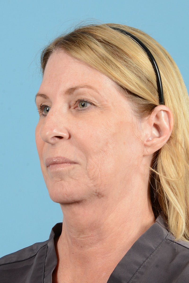 Facelift Before & After Gallery - Patient 188484 - Image 5