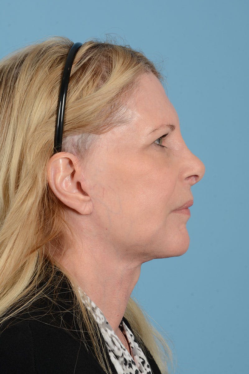 Facelift Before & After Gallery - Patient 188484 - Image 10