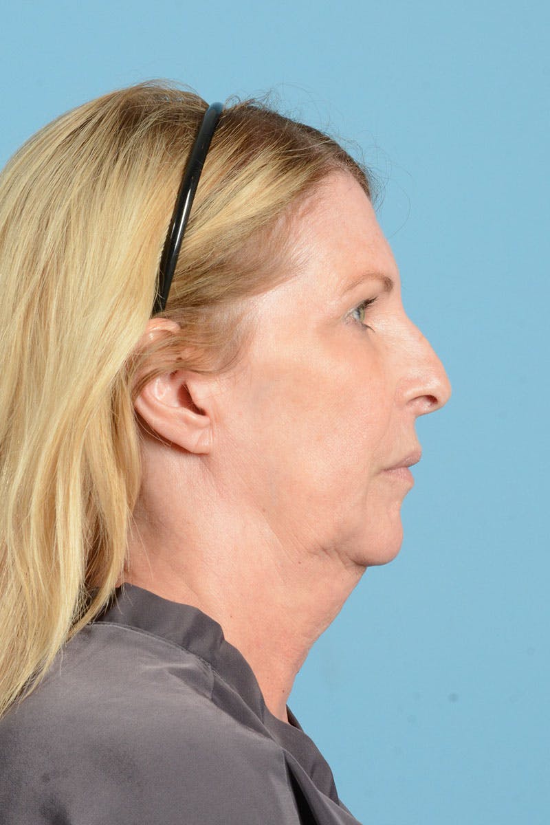 Facelift Before & After Gallery - Patient 188484 - Image 9