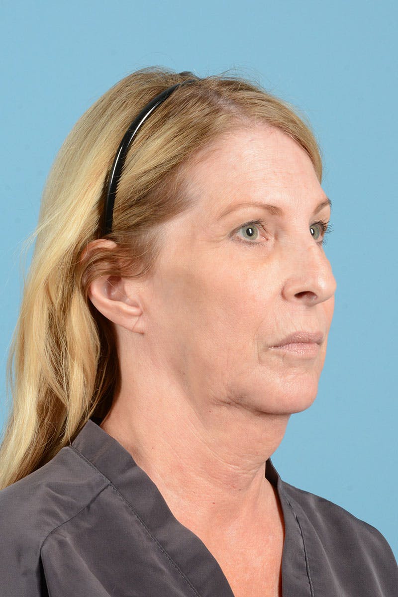 Facelift Before & After Gallery - Patient 188484 - Image 11