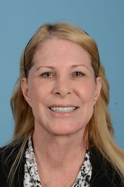 Facelift Before & After Gallery - Patient 188484 - Image 4