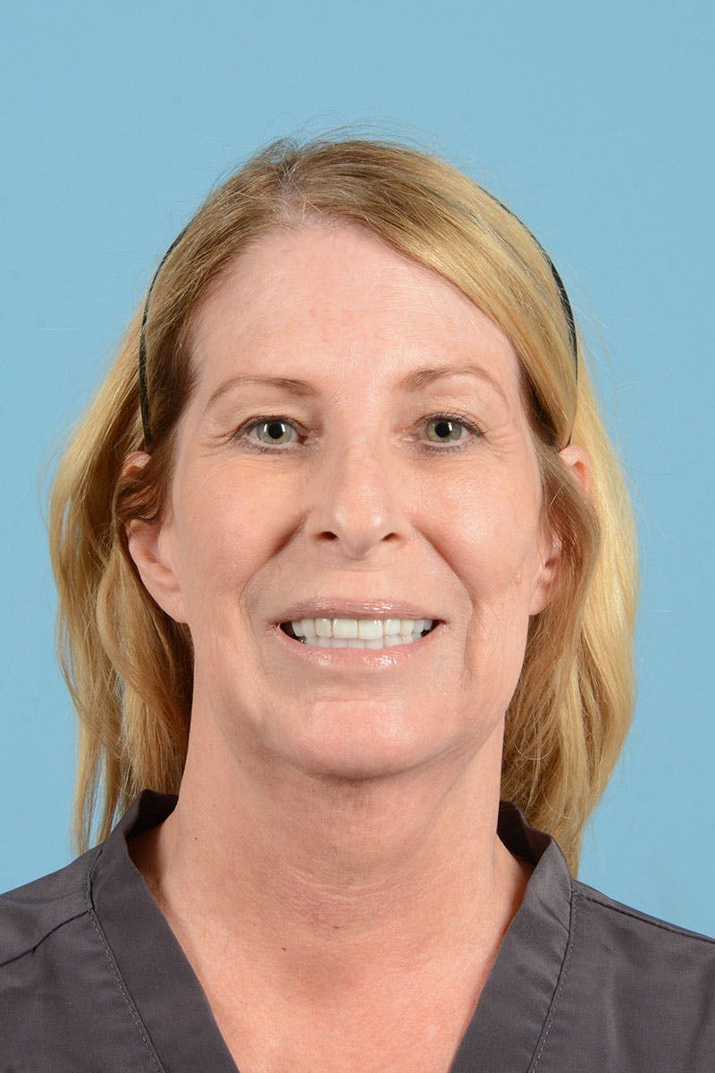 Facelift Before & After Gallery - Patient 188484 - Image 3
