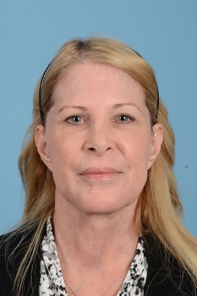 Facelift Before & After Gallery - Patient 188484 - Image 2