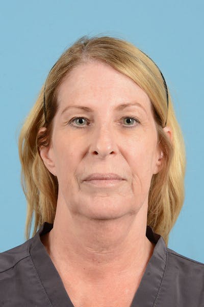 Facelift Before & After Gallery - Patient 188484 - Image 1