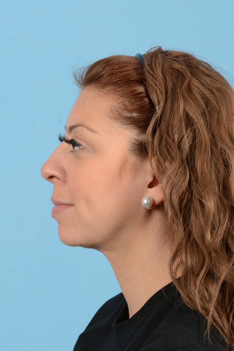 Liposuction Before & After Gallery - Patient 156216 - Image 6