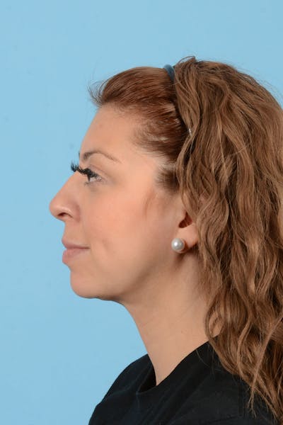Liposuction Before & After Gallery - Patient 156216 - Image 6