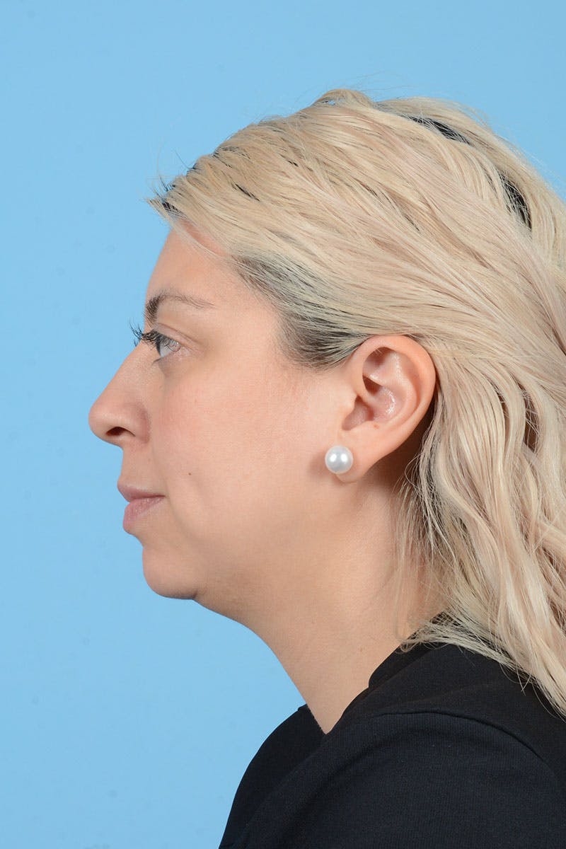 Liposuction Before & After Gallery - Patient 156216 - Image 5
