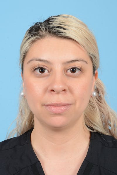Liposuction Before & After Gallery - Patient 156216 - Image 1