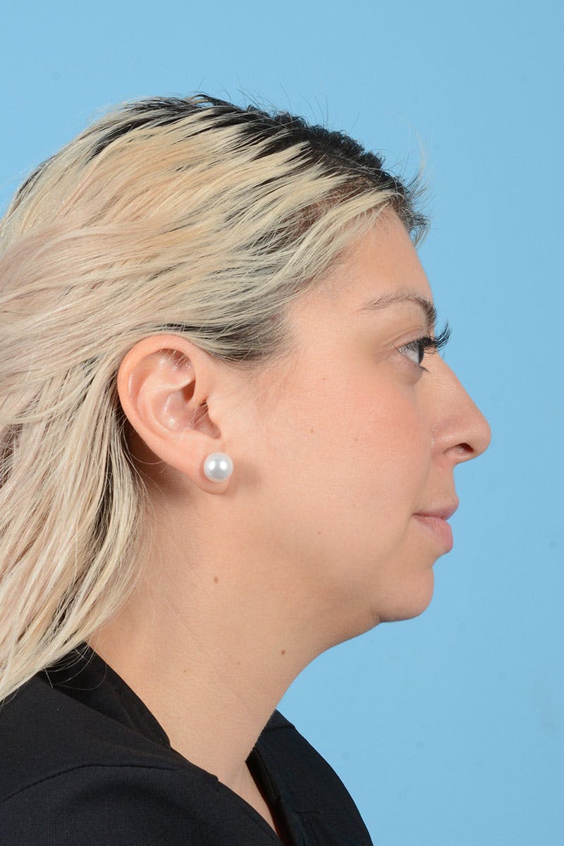 Liposuction Before & After Gallery - Patient 156216 - Image 7
