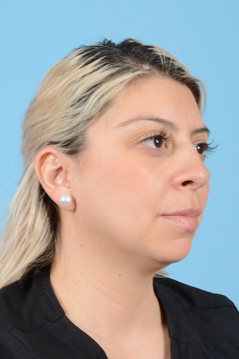 Liposuction Before & After Gallery - Patient 156216 - Image 9