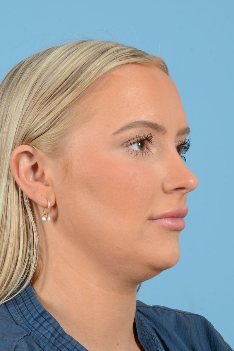 Liposuction Before & After Gallery - Patient 381753 - Image 9