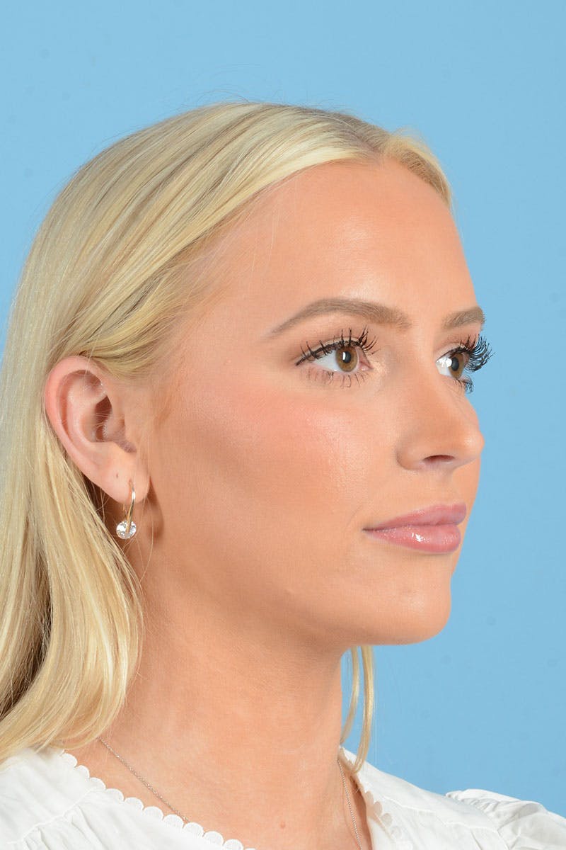 Liposuction Before & After Gallery - Patient 381753 - Image 10