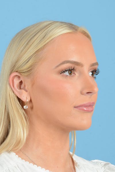 Liposuction Before & After Gallery - Patient 381753 - Image 10
