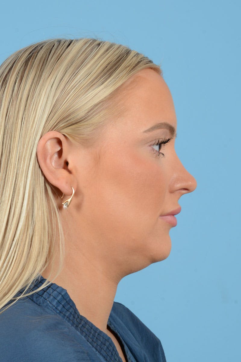 Liposuction Before & After Gallery - Patient 381753 - Image 7