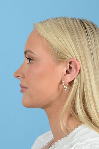 Liposuction Before & After Gallery - Patient 381753 - Image 6